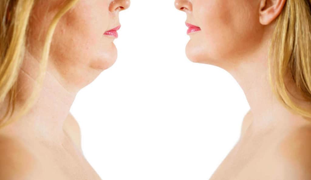 Double Chin treatment Hickstead before and after results