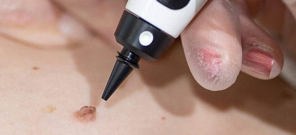 After Skin Tag Removal Hickstead