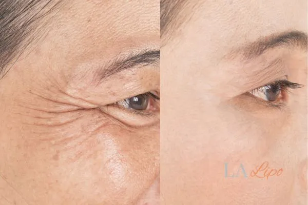 Before and after results of woman - HI-fu wrinkles reduction treatment Hickstead