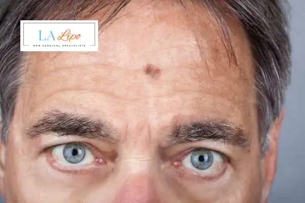 Solar Lentigo Removal Hickstead image of man with mark on his forehead