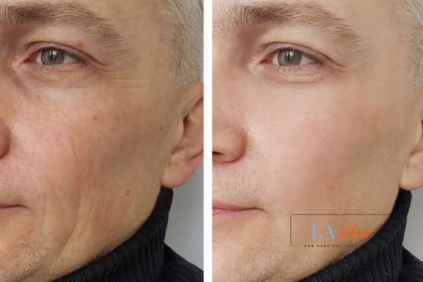 See the amazing results of Morpheus8 Treatment Hickstead!